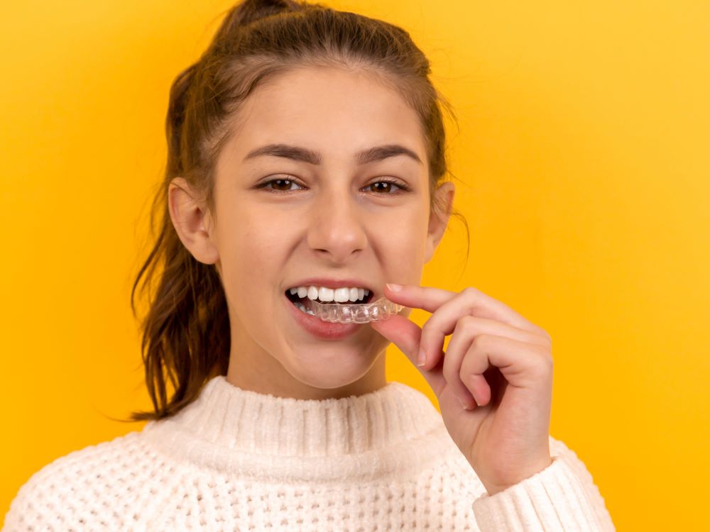 clear aligners