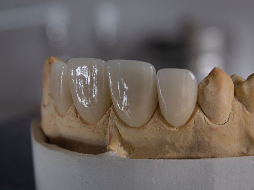 crowns