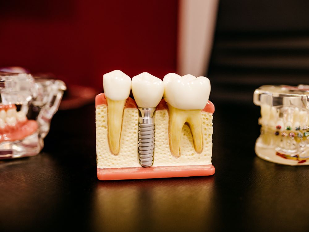 implant_crowns