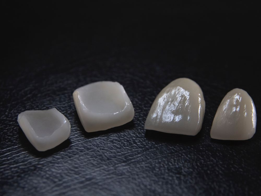 veneers